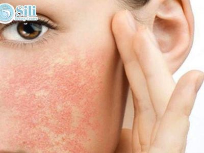 phục hồi da nhiễm corticoid