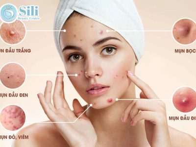 điều trị mụn