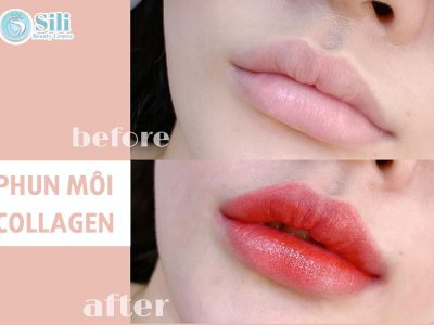 Phun môi Collagen