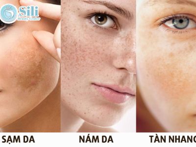 trị nám tàn nhang