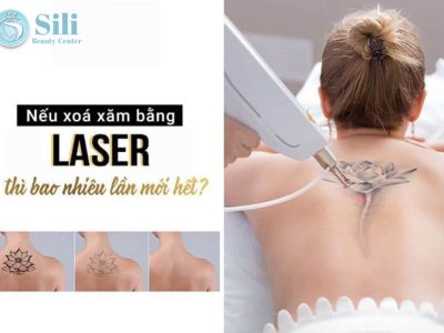 xóa xăm bằng laser