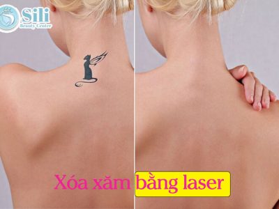 xóa xăm bằng laser