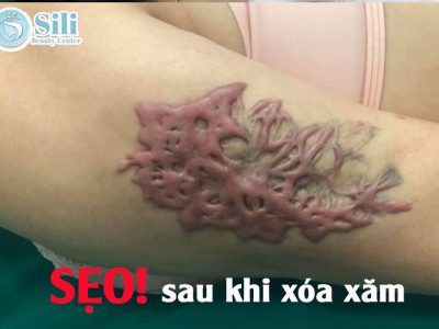 xóa xăm có để lại sẹo không