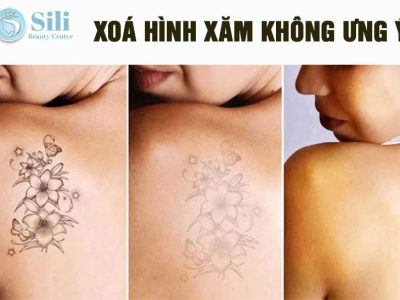 dịch vụ xoá xăm